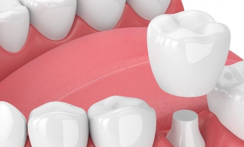 How Long Does Dental Crown Last?