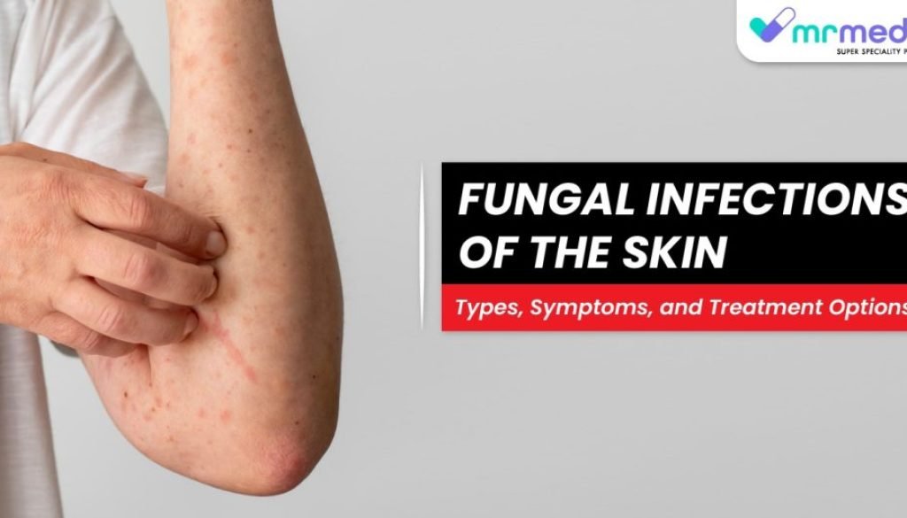 fungal-infections-of-the-skin-types-symptoms-and-treatment-options